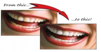 سفید کردن دندانها (بلیچینگ)