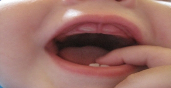 رشد دندانهای شیری
