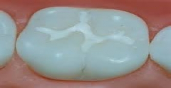 فیشور سیلنت محافظت از پوسیدگی دندانها