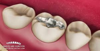 آیا بیش از 8 دندان پر شده دارید؟ این کار سطح جیوه در خون شما را ‏افزایش خواهد داد