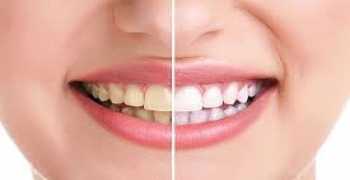سفید کننده های جدید دندان بدون تاثیرات جانبی