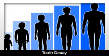 پوسیدگی دندان ممکن است در رشد کودکان اختلال ایجاد نماید