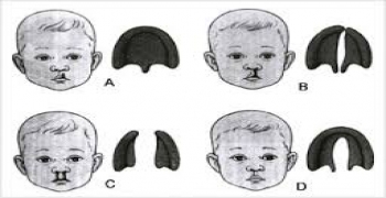 ‏محققین ژن عامل شکاف لب و سندروم بشقابی را شناسایی کردند