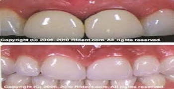 تاریخچه سفید کردن دندان