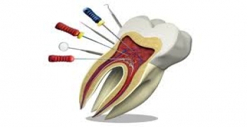‏دندانپزشکان تکه ای از ابزار دندانپزشکی را در کانال ریشه ی دندان بیمار جا گذاشتند