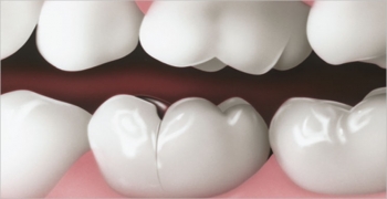 محققین بدنبال علت ایجاد ترک در دندان هستند ‏