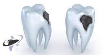 خمیرهای مصنوعی جدید پوسیدگی های اولیه دندان را ترمیم می کنند
